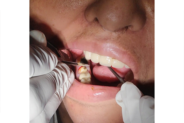Dental Treatments