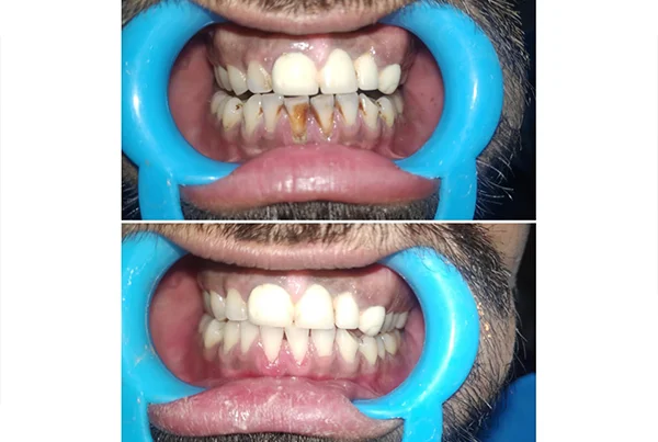 Dental Treatments