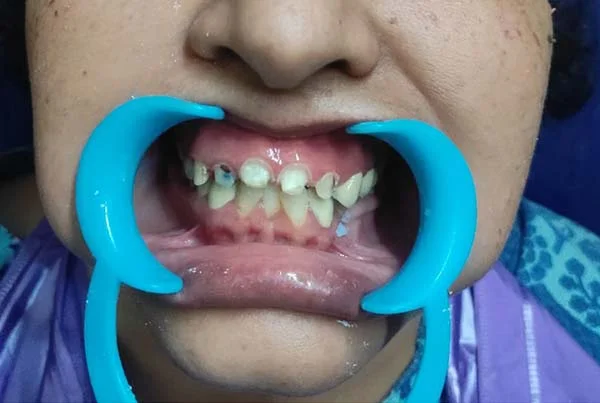 Dental Treatments