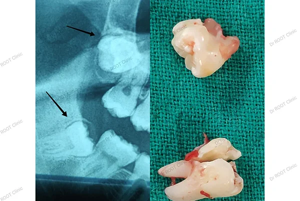 Dental Treatments
