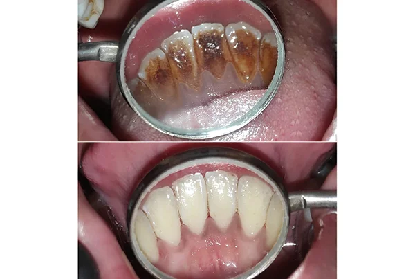 Dental Treatments