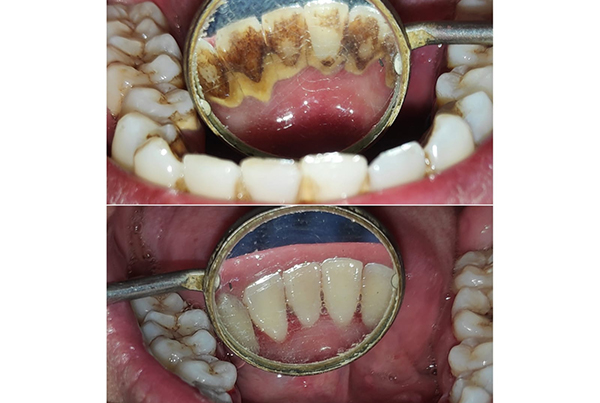 Dental Treatments
