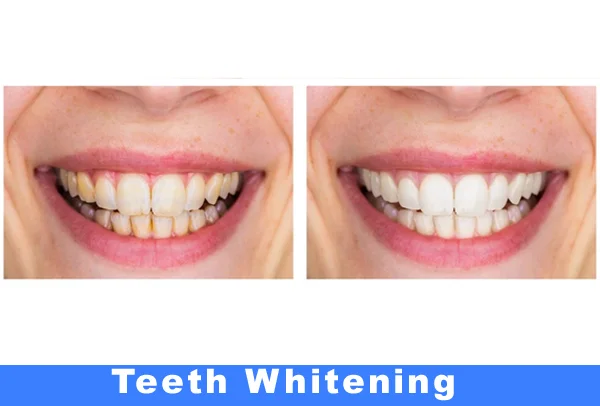 Teeth Whitening