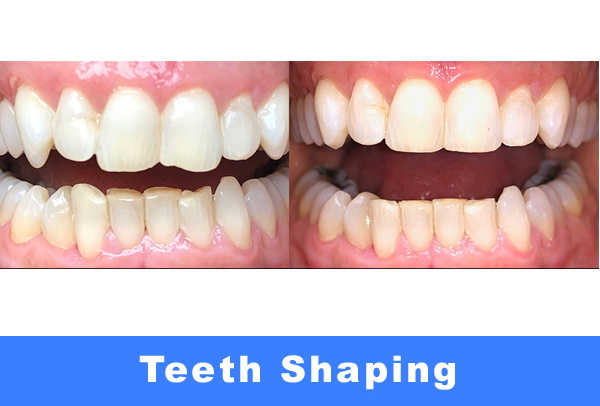 Teeth Shaping