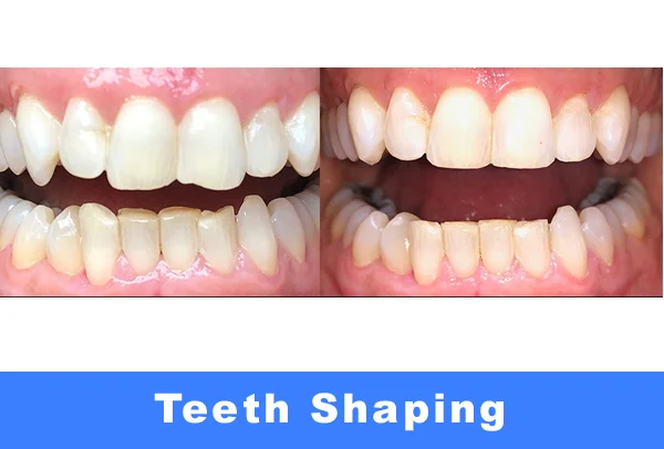 Teeth Shaping