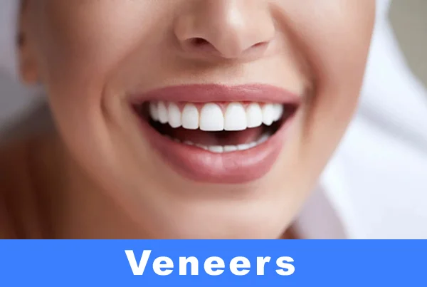 Veneering