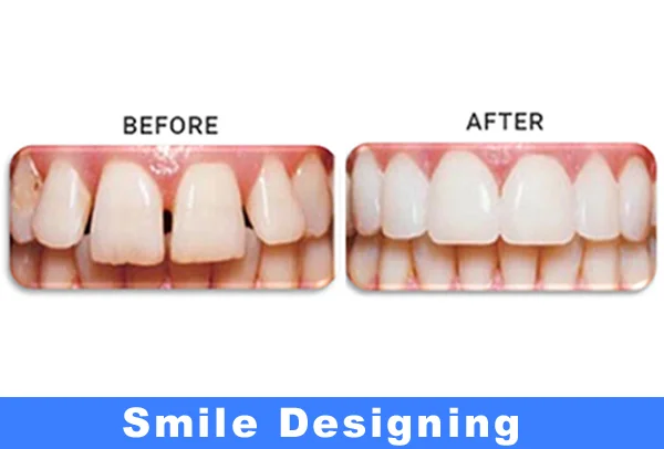 Smile Designing