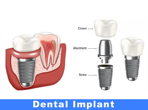 Dental Implants
