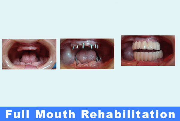 Full Mouth Rehabilitation