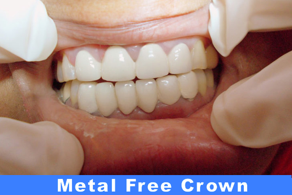 Metal Free Crowns