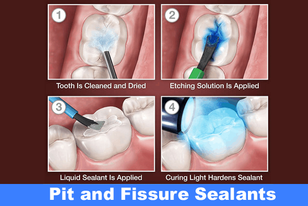 Pit and Fissure Sealants