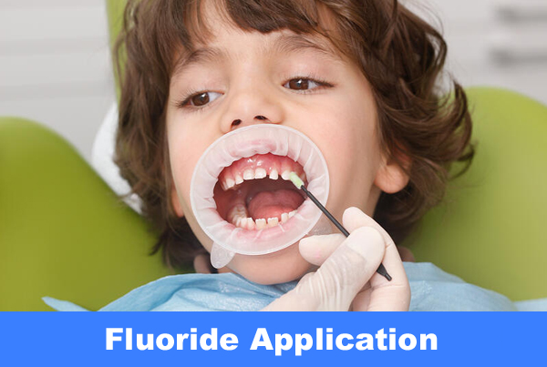 Fluroide Application