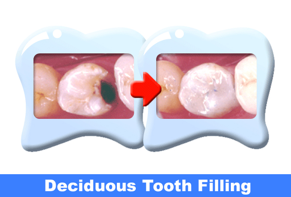 Deciduous Tooth Filling