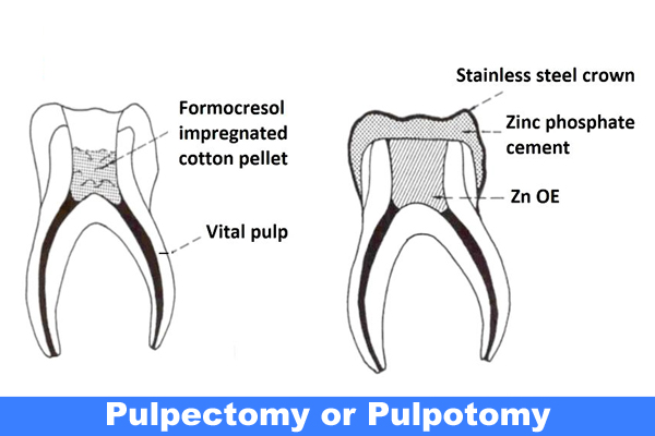 Pulpotomy and Pulpectomy 