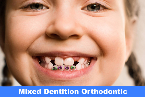 Mixed Dentition Orthodontic