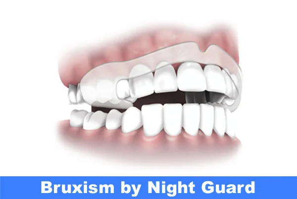 Bruxism By Night Guard