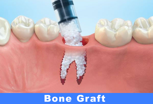 Bone Graft