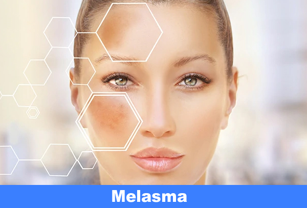 Melasma