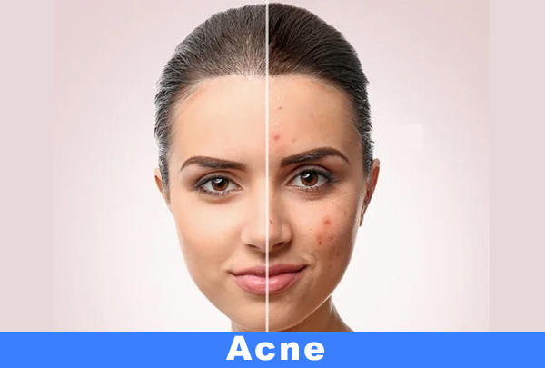 Acne Scar Treatment