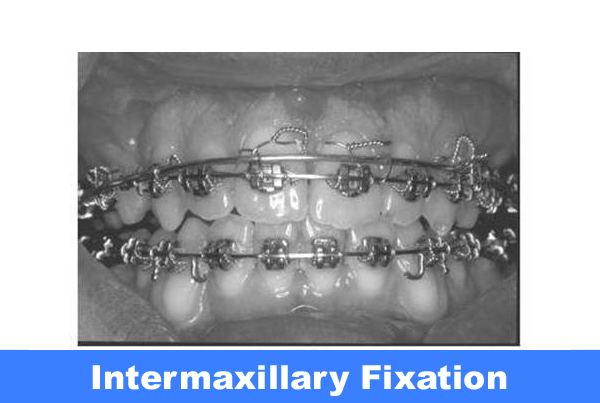 Intermaxillary Fixation
