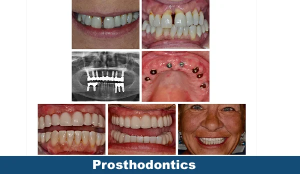 Prosthodontics