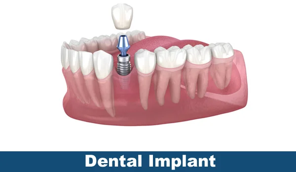 Dental Implant